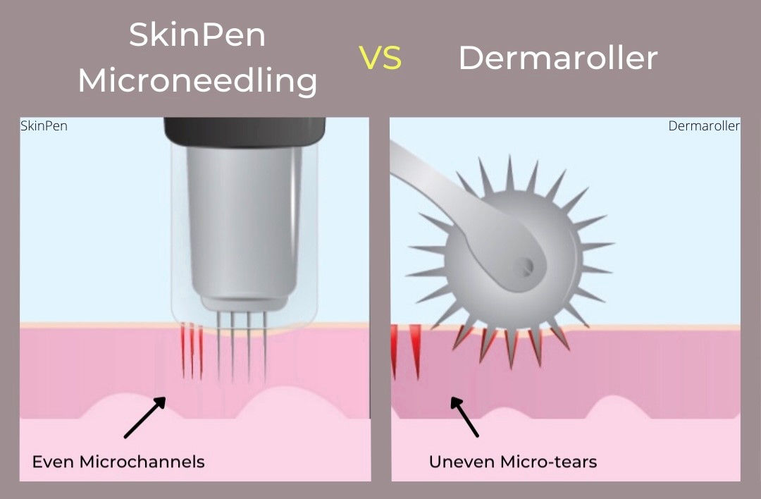 Microneedling Skinpen®